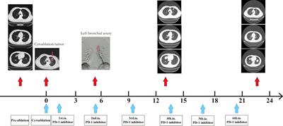 Investigation of the efficacy and safety of cryoablation and intra-arterial PD-1 inhibitor in patients with advanced disease not responding to checkpoint inhibitors: An exploratory study